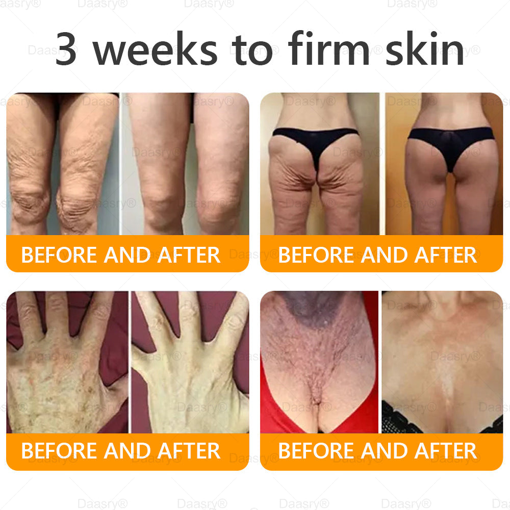 Daasry® Bee Venom Treatment Cream🍁 Targets wrinkles, purpura, sagging, stretch marks, dark spots, warts and more